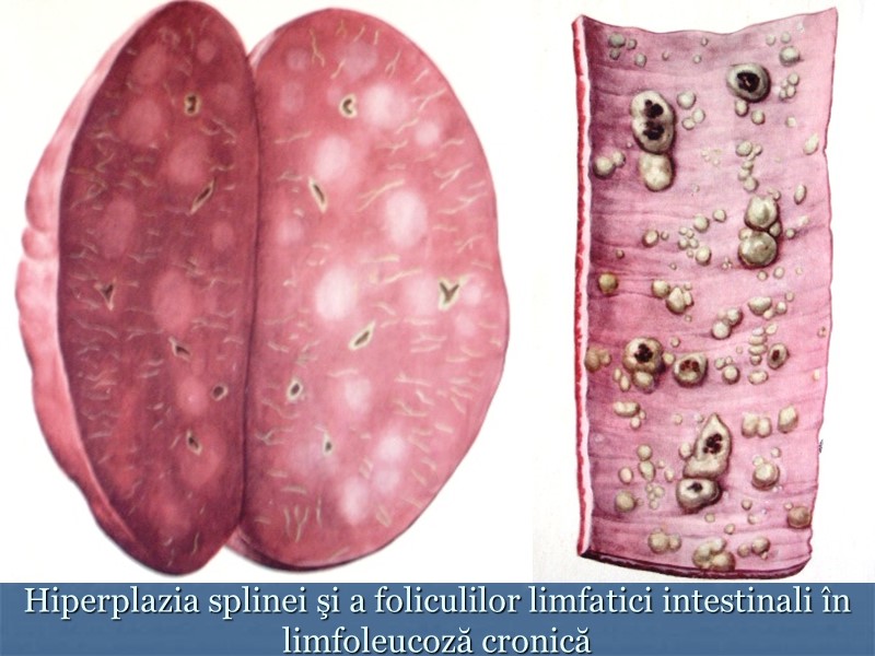 Hiperplazia splinei şi a foliculilor limfatici intestinali în limfoleucoză cronică